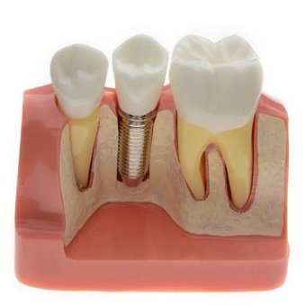Dental Demonstration Teeth Model Implant Analysis Crown Bridge 2017 - intl