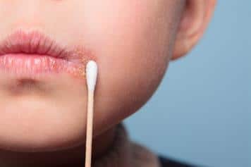 1 หลอด Vivax Cream 5g 1หลอด ครีมทาเริม เริมที่ปาก อวัยวะเพศ งูสวัด |  Lazada.co.th