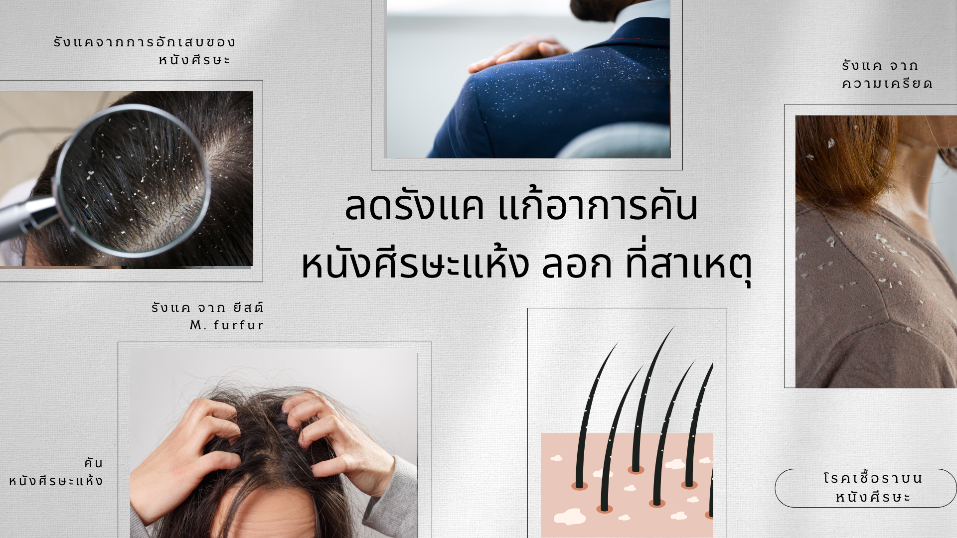 รังแคเกิดจากเชื้อรา ยีสต์ แชมพูขจัดรังแค จากสมุนไพรไทยและเกาหลี 16 ชนิด ช่วยได้
