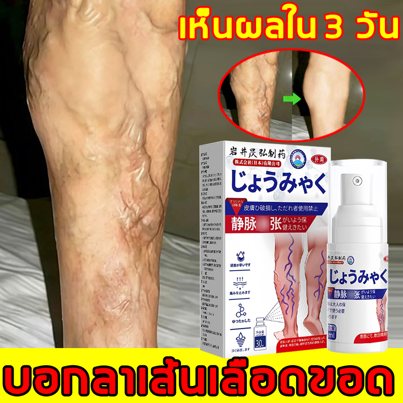 Varicose Vein Cream Helps Make Your Legs Look Smoother. Also Nourishes the Skin and Adds Comfort to the Legs. Vein Cream. Varicose Vein Cream. ราคา 169 บาท*ส่งฟรี