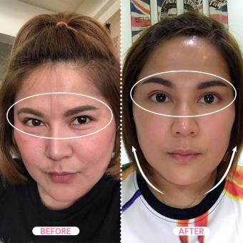 Dora : VL Verbena Lifting Serum ( VL น้ำตบยกกระชับ หน้าเรียว) July 2018 - 5 Dora : VL Verbena Lifting Serum ( VL น้ำตบยกกระชับ หน้าเรียว) - 5