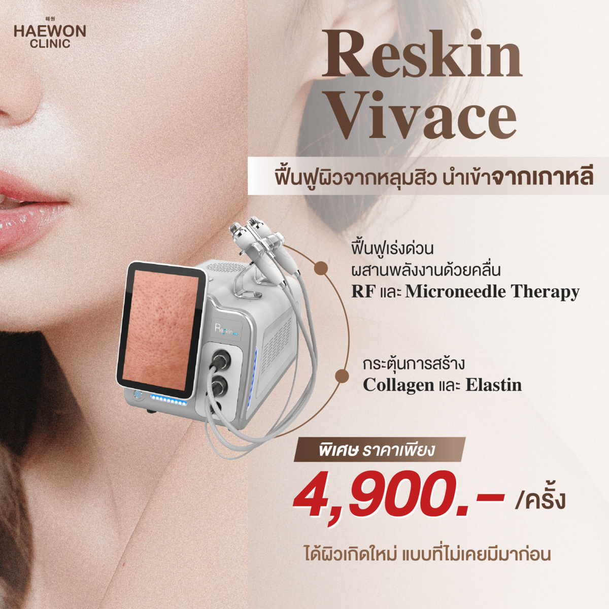 [E-voucher] Vivace Reskin กู้ผิวจากหลุมสิว เปลี่ยนหน้ารูให้เรียบเนียน ยกกระชับผิวx3 จากแฮวอนคลินิก Haewon Clinic ราคา 4,900 บาท*ส่งฟรี