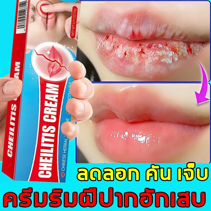 Anti-Inflammatory Lip Cream, Cream for Treating Lip Inflammation Caused by Herpes, Antibacterial Cream for Herpes, Cream for Nourishing Dry, Cracked and Wrinkled Lips, 20g ราคา 149 บาท*ส่งฟรี