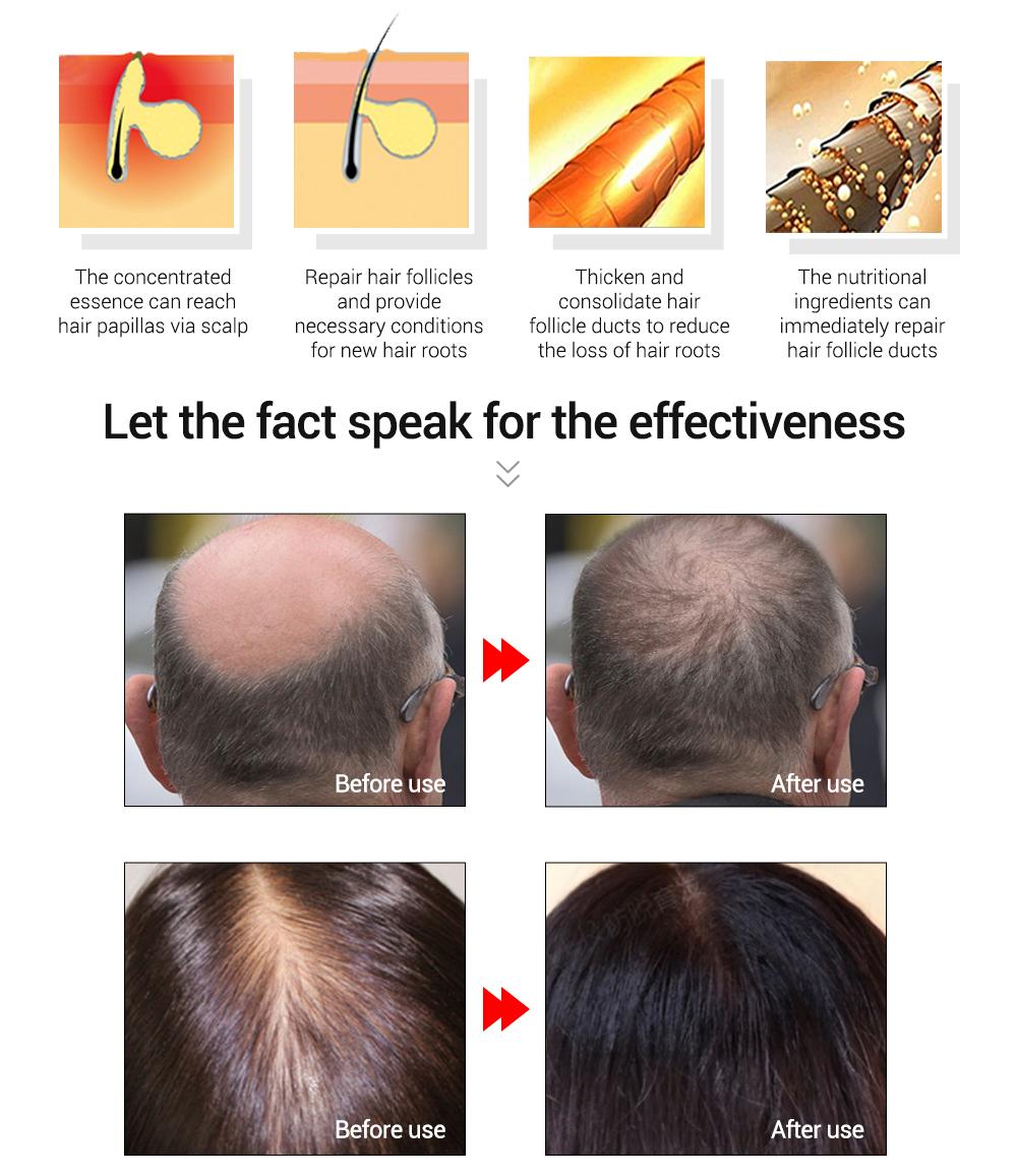 Original Lanbena Hair Growth Hair Loss Grower Oil Essence 20ml