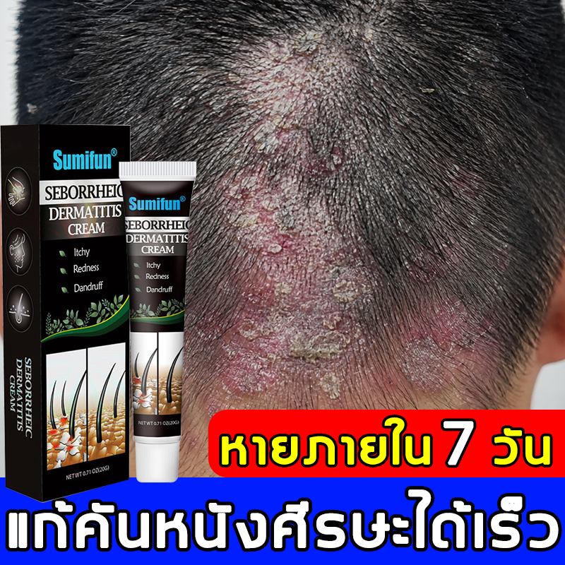 Cream to Reduce Itching Suitable for Psoriasis, Scalp Inflammation, Fungus, Ringworm, Ringworm, Dermatitis, Bacterial Infection, Itching, Hives, Allergic Rash, Dandruff, Acne, and Inflammation of the Pores on the Scalp and Face. Anti-Itch Cream. ราคา 149 บาท*ส่งฟรี