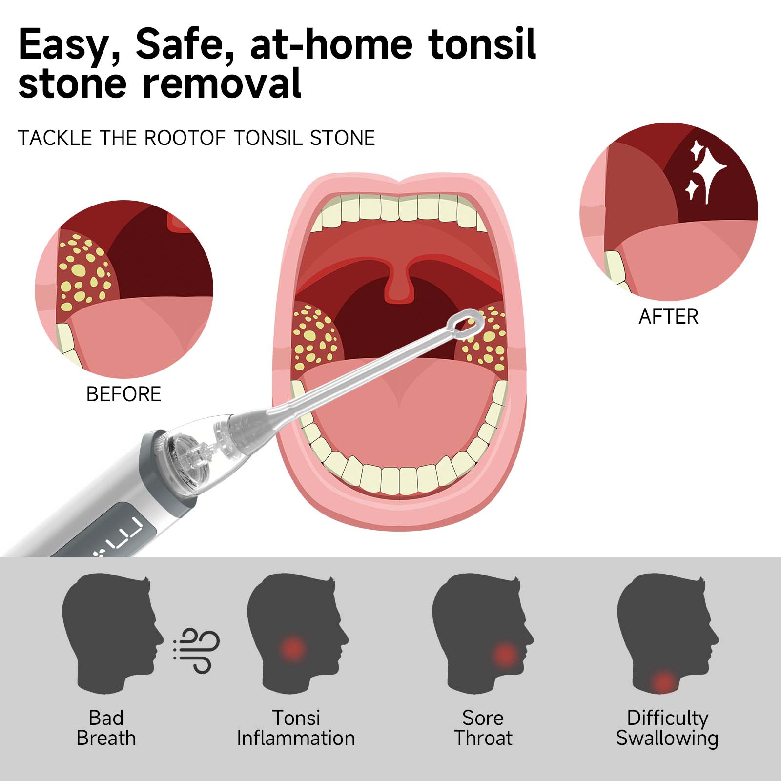 iKeener Vacuum Tonsil Stone Remover Tool Built-In LED light Suction Modes Anti Bad Breath Oral Irrigator&Tongue Coating Scrape ราคา 842 บาท*ส่งฟรี