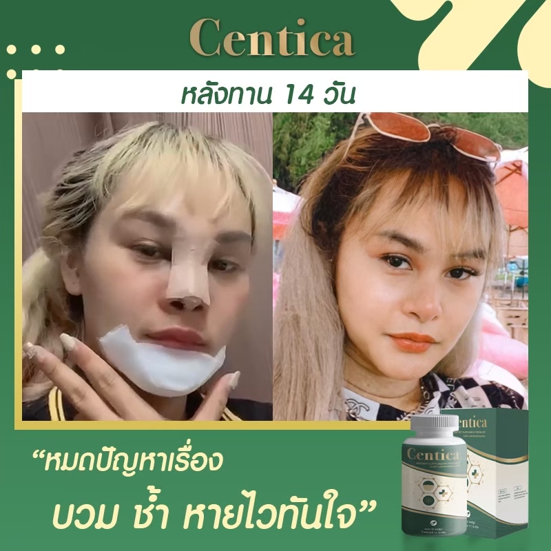 รูปภาพรายละเอียดของ Centica อาหารเสริมเพื่อการฟื้นฟู ลดบวมช้ำ ลดการเกิดรอยแผลเป็นหลังศัลยกรรม 2 กระปุก