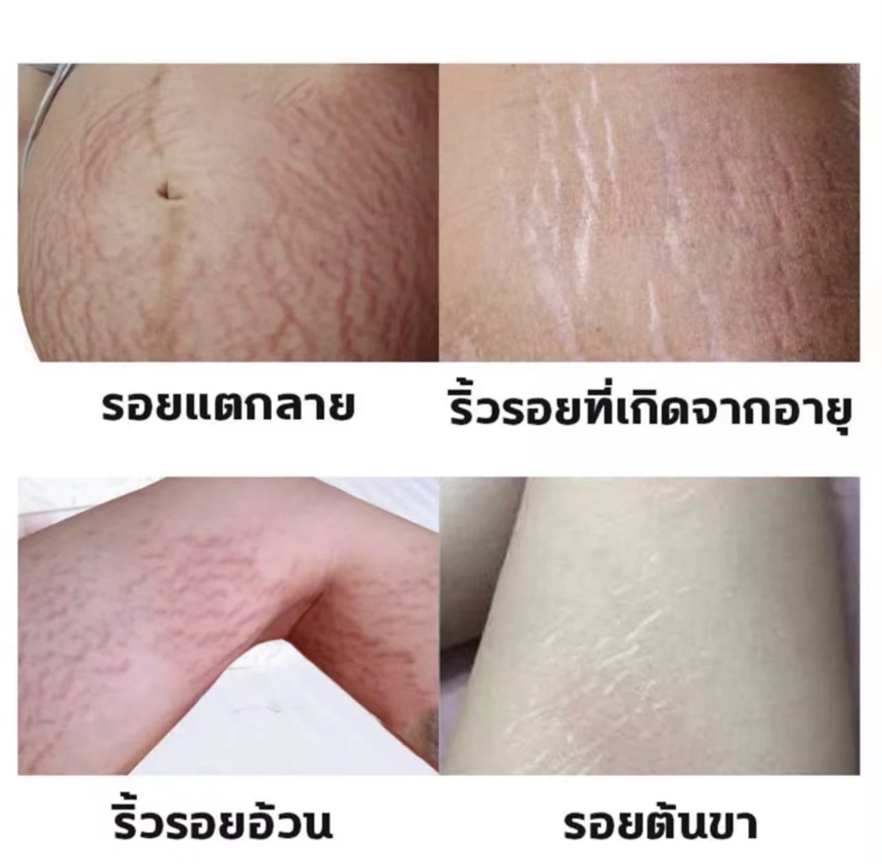 Aichunครีมกันแตกลาย ครีมลดรอยแตกลาย60กรัม ครีมทาท้อง ครีมทาท้องลาย แก้แตกลาย  ครีมแก้ท้องแตกลาย ครีมแก้ท้องลาย ลดผิวแตกลาย ครีมลดรอยแตก ครีมทาท้องแตก กัน ท้องลาย ครีมท้องแตกลาย ครีมทาขาแตกลาย ครีมทาหน้าท้อง ครีมทารอยแตก ครีมแก้ขา ลาย | Lazada.Co.Th