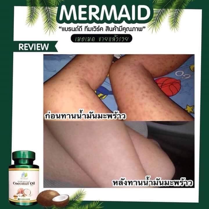 เกี่ยวกับ Mermaid Cold Pressed Coconut Oil น้ำมันมะพร้าวสกัดเย็น 100% เซ็ต 3 กระปุก (40 เม็ด / กระปุก)