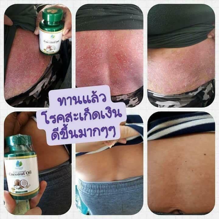 เกี่ยวกับ Mermaid Cold Pressed Coconut Oil น้ำมันมะพร้าวสกัดเย็น 100% เซ็ต 3 กระปุก (40 เม็ด / กระปุก)